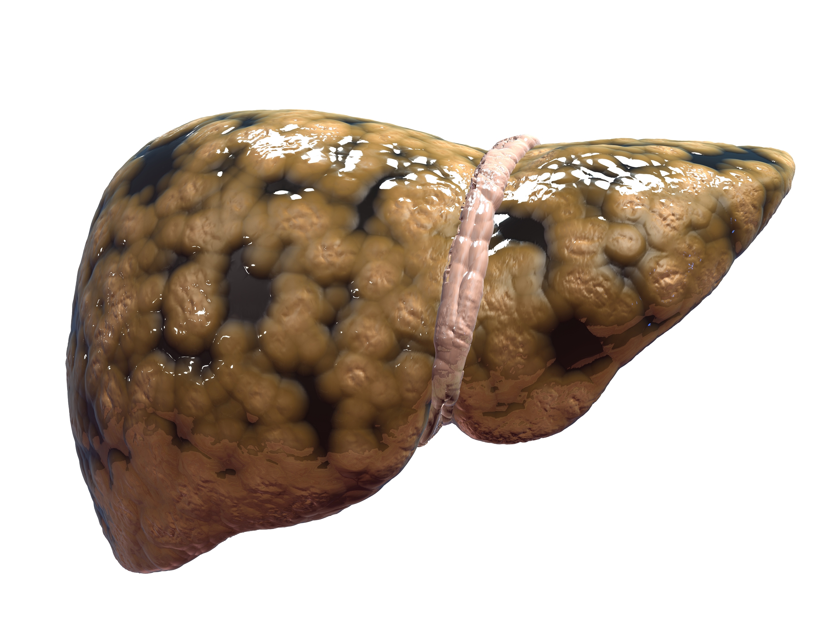 Fatty liver - What is it? - Welcome to Baliga Diagnostics